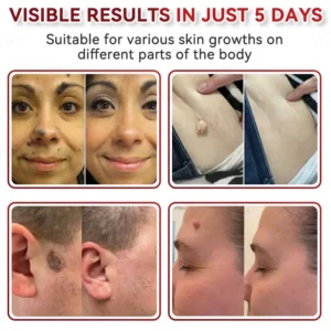 CZTICLE® 💧Microneedles Botanical Skin Tags Solution Patches - Made in the USA👩‍⚕️