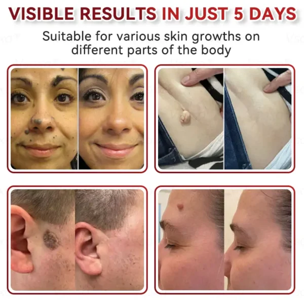 CZTICLE® 💧Microneedles Botanical Skin Tags Solution Patches - Made in the USA👩‍⚕️