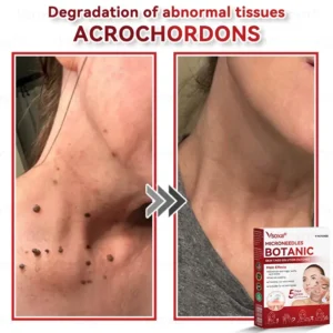 CZTICLE® 💧Microneedles Botanical Skin Tags Solution Patches - Made in the USA👩‍⚕️