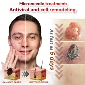 CZTICLE® 💧Microneedles Botanical Skin Tags Solution Patches - Made in the USA👩⚕️