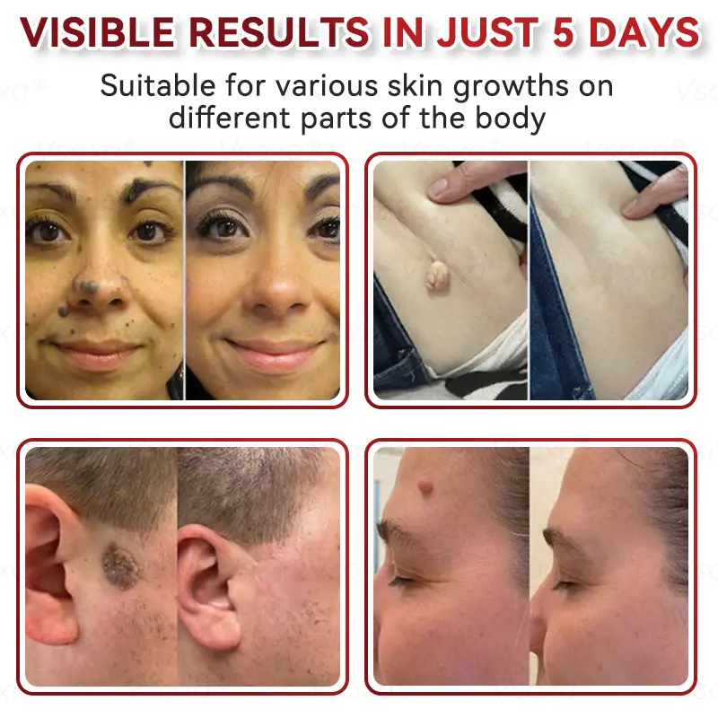 CZTICLE® 💧Microneedles Botanical Skin Tags Solution Patches - Made in the USA👩⚕️