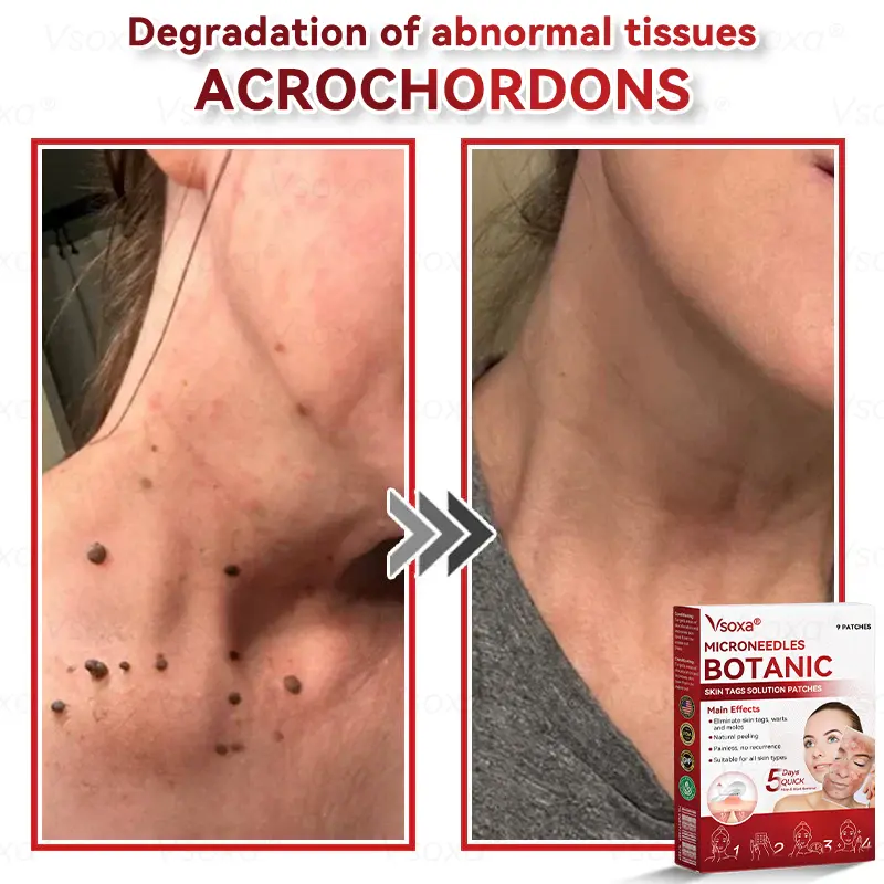 CZTICLE® 💧Microneedles Botanical Skin Tags Solution Patches - Made in the USA👩⚕️
