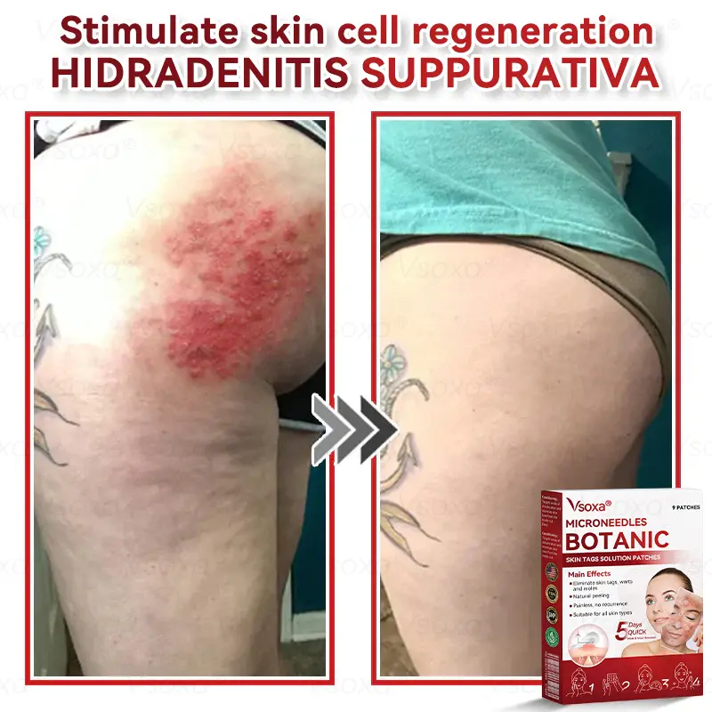 CZTICLE® 💧Microneedles Botanical Skin Tags Solution Patches - Made in the USA👩⚕️